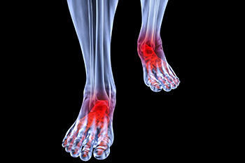 arthritic foot care