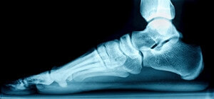 Two Categories of Flat Feet