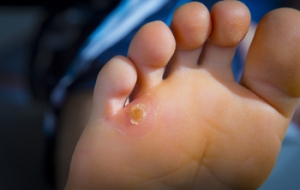 Wearing Shoes That Do Not Fit Properly May Cause Corns