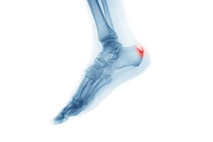 What Is a Heel Spur?