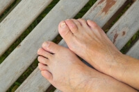 Hammertoe in Kids