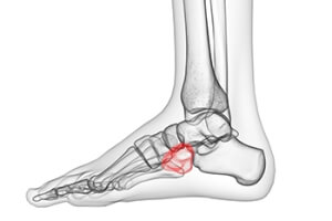 Cuboid Fractures