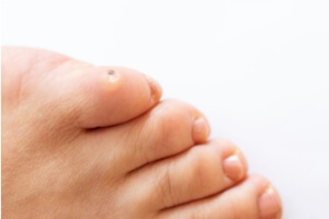 Common Causes of Foot Corns