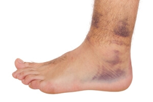 Spraining an Ankle