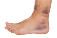 Spraining an Ankle