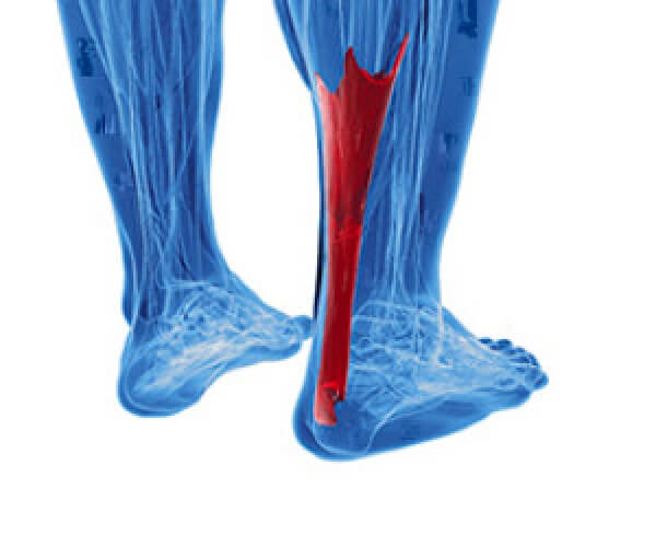 How Do Achilles Tendon Injuries Occur?