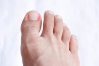 Reasons Why an Ingrown Toenail Can Develop