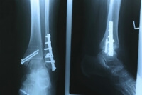 What Happens When a Stress Fracture Occurs?