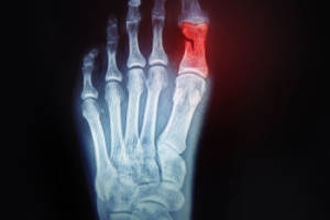 Podiatric Care for a Broken Toe