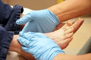 Diabetic Foot Ulcers
