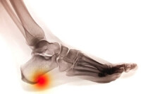 What Causes Heel Spurs?