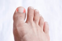 Reasons Why an Ingrown Toenail Can Develop