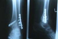 What Happens When a Stress Fracture Occurs?
