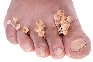 About Toenail Fungus