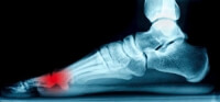 Are You at Risk for Sesamoiditis?