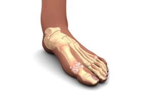 Gout Is a Form of Arthritis