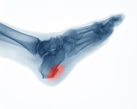 What Condition Can a Heel Spur Be Linked To?