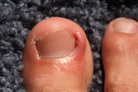 Stages of an Ingrown Toenail