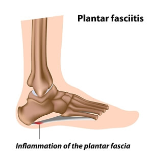 Can Sudden Weight Gain Cause Plantar Fasciitis?